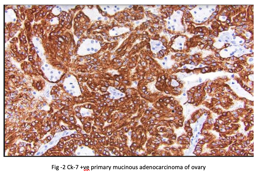 Mucinous Cystadenocarcinoma of Ovary: 10 Years Experience of a Tertiary Cancer Institute, ahpgic